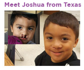 Joshua is a young advocate for children with facial differences. 